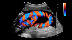 Color Doppler